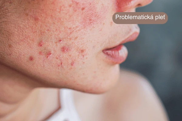 kosmetické ošetření problematické pleti