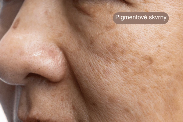 pigmentové skvrny kosmetika Praha